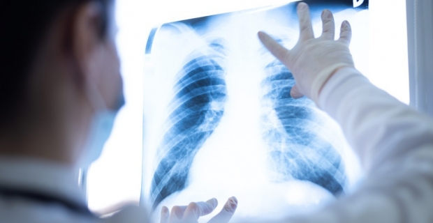 Covid-19 nodülleri akciğer kanseri başlangıcı olabilir